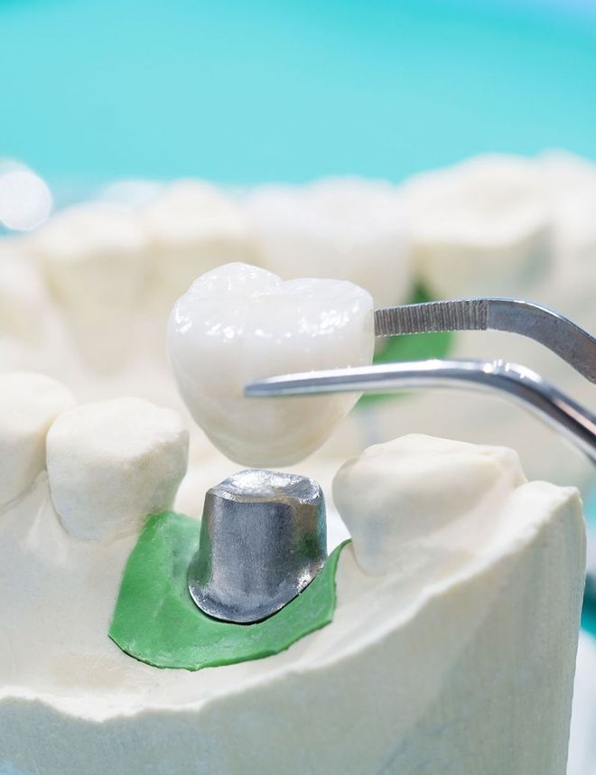 Zahnkrone wird mit einer Pinzette über einem vorbereiteten Zahnimplantat positioniert